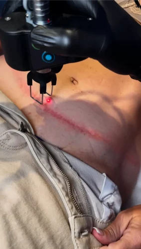 CoolPeel® CO2 Laser for Body services at 5th and Wellness in Boca Raton, FL