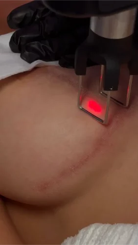 CoolPeel® CO2 Laser for Body why choose one services at 5th and Wellness in Boca Raton, FL